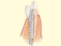 Bild 2 Kohl in Schwabach